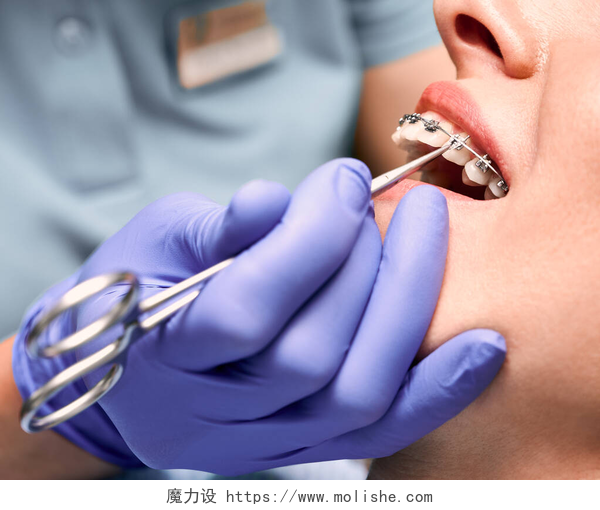 医生在给病人带牙套牙科医生用手把弹性橡皮筋贴在病人的支架上.牙齿上有金属丝支撑的妇女正在接受牙齿矫正治疗。口腔学、牙科学和正畸学的概念.